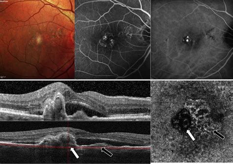 Polypoidal Choroidal Vasculopathy Landmark Studies Farabi Retina