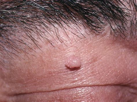 Skin Tags Causes And Removal Tips Beauty And Grooming Guru