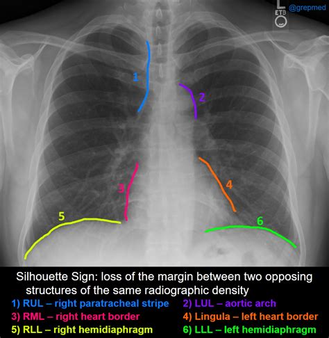 Silhouette Sign On Chest X Ray Loss Of The Margin Between Grepmed