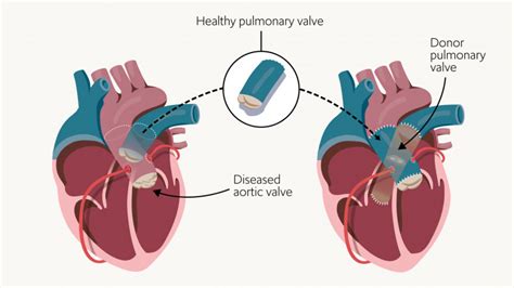 Aortic Valve Replacement In Young Adults Rbandhh Specialist Care