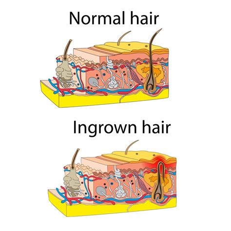 Why do we have pit hair, anyway? Eingewachsene Haare