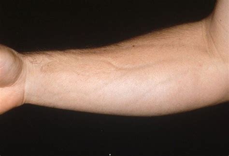 Scleroderma As Related To Eosinophilic Fasciitis Pictures