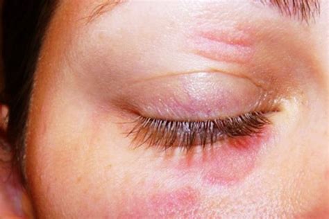 Infected Eye Types Causes And Treatment 58d