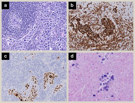 An Update On High Grade B Cell Lymphoma Diagnostic Histopathology