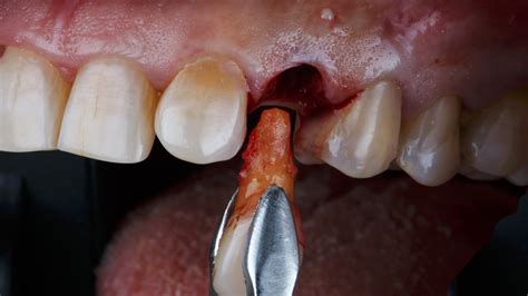 Atraumatic Tooth Extraction Pearl Dental Clinic Dentist In London