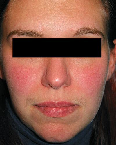 The Many Faces Of Rosacea