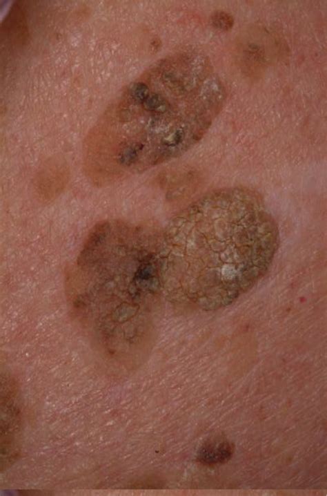 Types Of Keratosis Pictures Photos