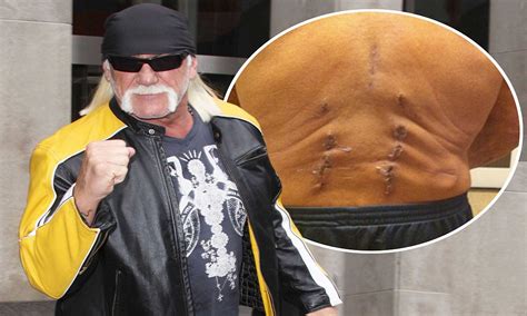 Hulk Hogan Shows Off Graphic Puncture Wounds On His Back After Having Spine Rebuilt Daily Mail