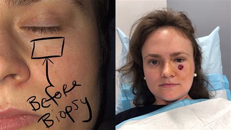 Woman 24 Recovering From Skin Cancer On Face After She Thought It Was