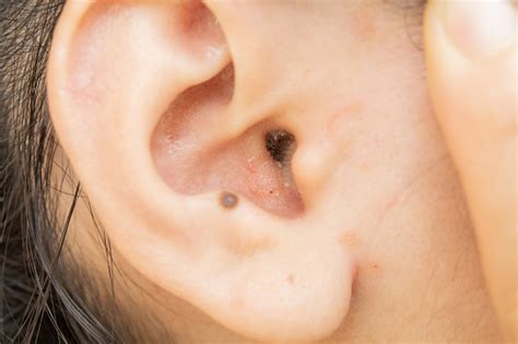Dry Skin Disease In The Ear Stock Photo Download Image Now Istock