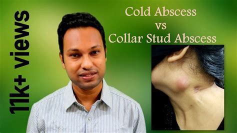 Cold Abscess Vs Collar Stud Abscess Stages Of Tubercular