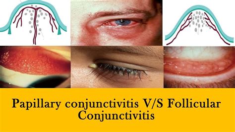 Conjunctivitis Papillae Vs Follicles And Membranes Youtube