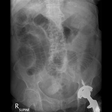 Gallstone Ileus Radiology Case Radiology Medical Radiography Radiology