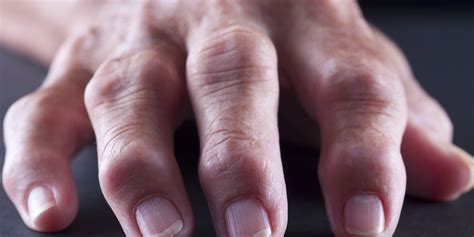 12 Causes Of Swollen Fingers Why Your Fingers And Hands Swell