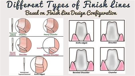Finish Lines In Fixed Partial Denture