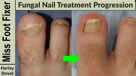 Fungal Nail Treatment Progression 10 Year Infection By Marion Yau Miss