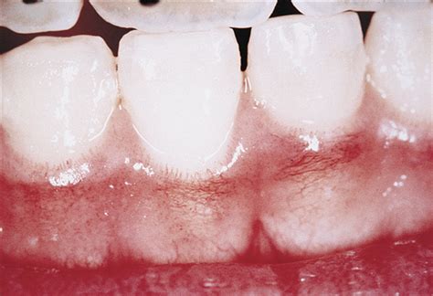 Gingival Telangiectases An Underappreciated Physical Sign Of Juvenile