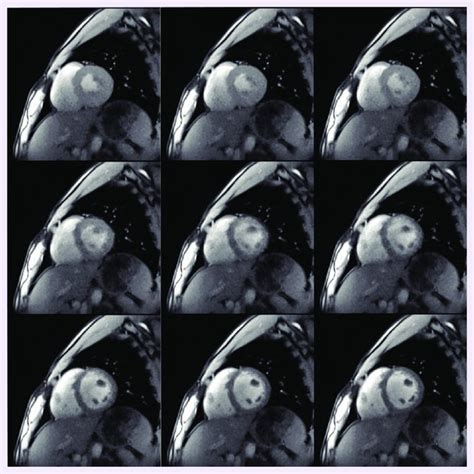 Real Time MRI Of Natural Swallowing Using Ml Pineapple Juice As MRI Download Scientific