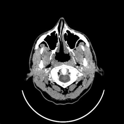 Muscle Ct Scan Neck Skull Head And Neck Cts
