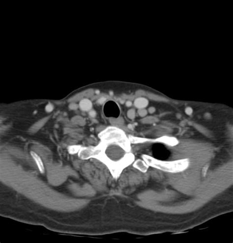 Cervical Lymphadenopathy Radiology Case