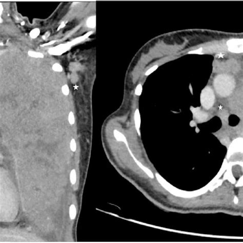 A B Post Contrast Ct Thorax Images In Coronal And Axial Sections