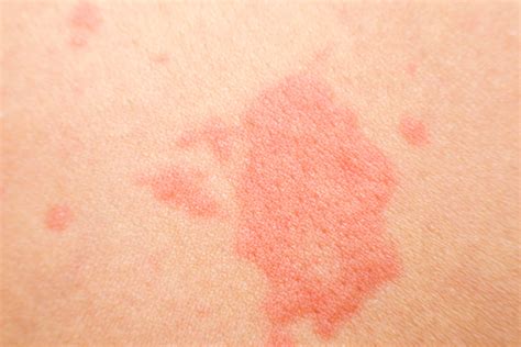 Red Spots On Skin Pictures Causes Treatment Online Dermatology Images And Photos Finder