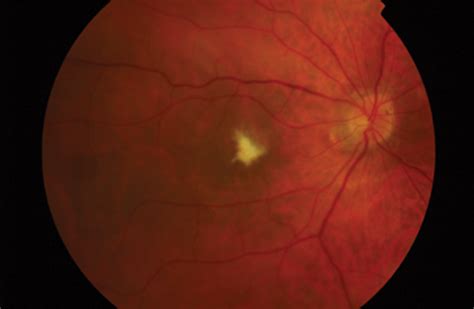 Macula Re Attachment Following Intravitreal Ranibizumab In