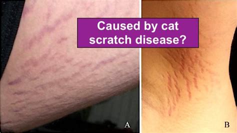 Cat Scratch Can Make You Schizophrenic But Antibiotics Fixes The
