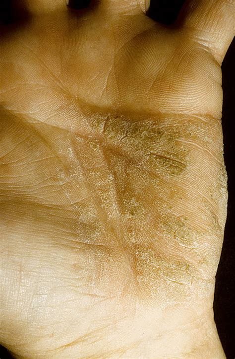 Eczema On The Palms Pictures 224 Photos And Images