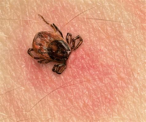 Pin On Lyme And Tick Borne Illnesses And Fundraising For Treatment