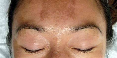 Melasma Causes What Causes The Dark Spots On My Skin