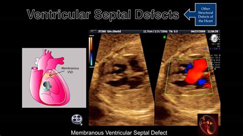 Fetal Echocardiography Ventricular Septal Defects Youtube