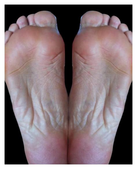 A Foot Dermatitis Before Diagnosis Of Toxocara Infections B Foot