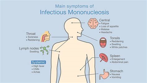 Mono Mononucleosis Diagnosis And Treatment