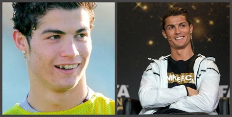 Cristiano Ronaldo Dents Avant Et Après Une Sélection De Photos