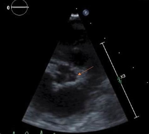 Echocardiogram Images Showing A Dysplastic Left Aortic Valve Leaflet