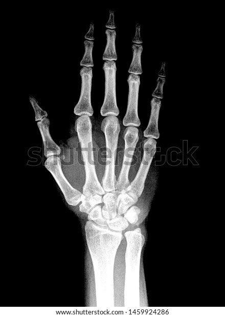 Wrist X Ray Anatomy Radiology Radiographic Stock Photo 1459924286