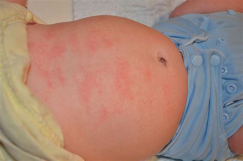 Skin Rashes In Babies