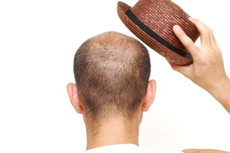 Does Wearing A Hat Cause Baldness Hair Loss Treatment