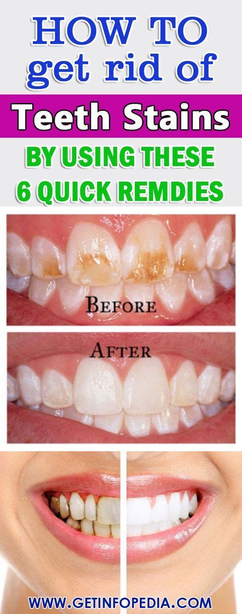 Coffee is one of the strongest elements, and it is tough to get rid of the coffee stains on the teeth, but there are a few remedies that can work. Home Remedies To Get Rid Of Teeth Stains | How to get ...