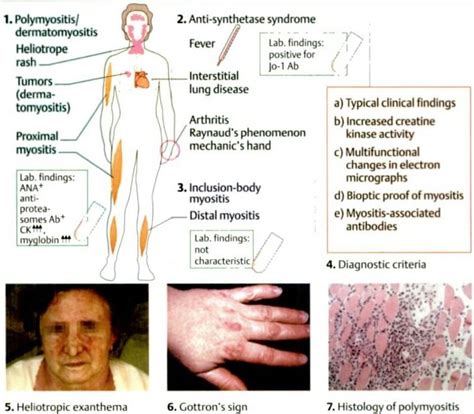 Myositic Diseases Polymyositis Dermatomyositis Dermatomyositis