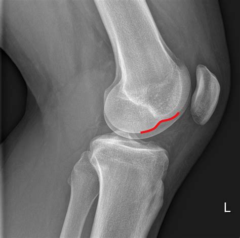 A Typical Sign On A Plain Knee Radiograph The Bmj