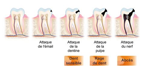 Névralgie Dentaire Origine Symptômes Et Traitement