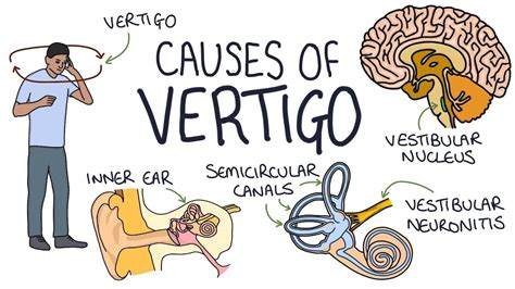 Understanding The Causes Of Vertigo Youtube Vertigo Vertigo Causes