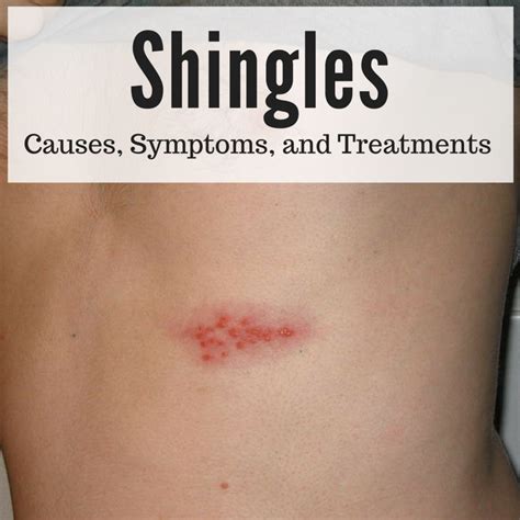 Shingles A Serious And Painful Disease Healthproadvice