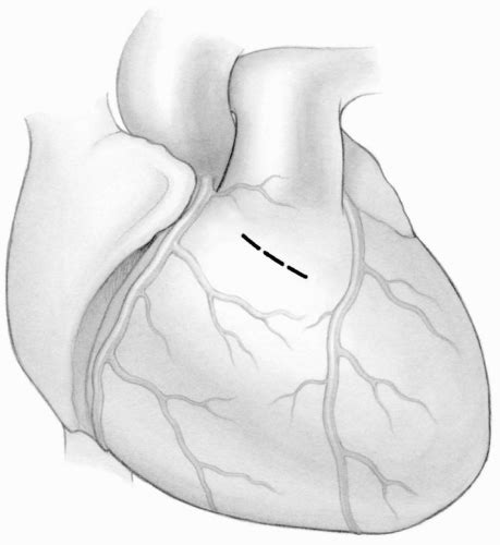 Right Ventricular Outflow Tract Obstruction Thoracic Key