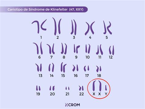 Ficha Técnica Síndrome De Klinefelter Crom Instituto De Citogenética Humana