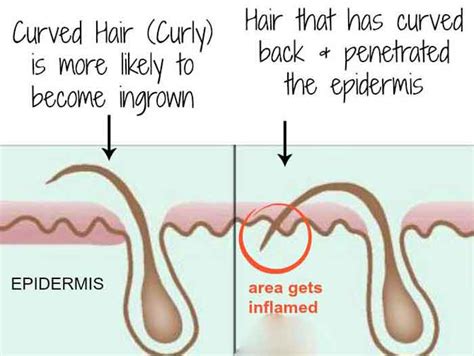 As much as ingrown hairs and herpes have some similar symptoms, their treatment options differ. Ingrown Hair vs Herpes -Ingrown Hair or Herpes-What's the ...