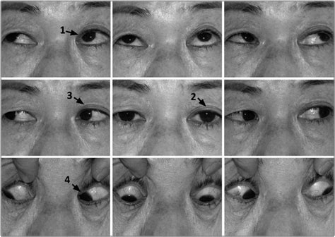 Inferior Oblique Palsy