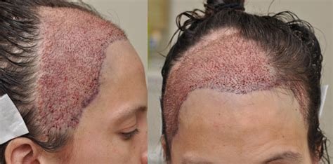 Hair Restoration In A Female Patient Post Craniotomy And Radiation Treatment For Astrocytoma